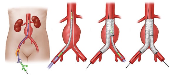 Image of endovascular repair of an abdominal aortic aneurysm